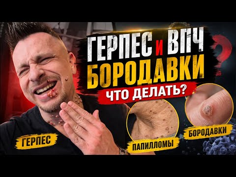 Бородавки, папилломы, герпес — откуда берутся и как убрать Бородавки, папилломы, герпес — откуда берутся и как убрать