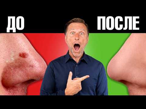 Вот ПОЭТОМУ вы не можете избавиться от акне и угревой сыпи😲