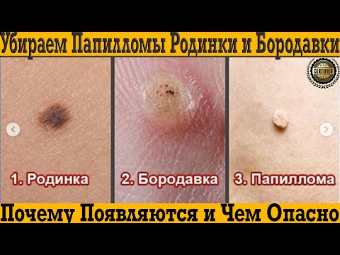Как убрать папилломы, родинки и бородавки! Чем они опасны, почему появляются?!