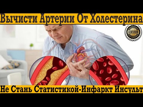 Не стань статистикой! Профилактика инфаркта и инсульта! Вычисти артерии от холестерина!