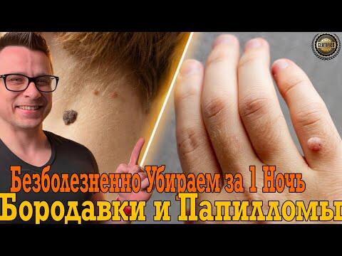 Убираем бородавки и папилломы за ночь! Убираем бородавки и папилломы за ночь!