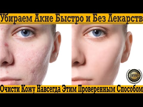 АКНЕ больше НЕТ! Очисти кожу навсегда уже сегодня!