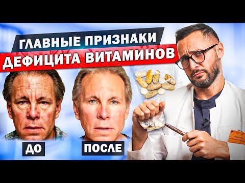 Внешние проявления недостатка витаминов. Витамины A, C, B, D, E, K Внешние проявления недостатка витаминов. Витамины A, C, B, D, E, K