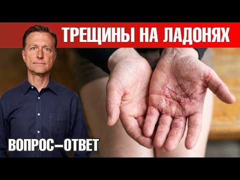 Экзема на ладонях: почему кожа не заживает и что делать🧐 Экзема на ладонях: почему кожа не заживает и что делать🧐