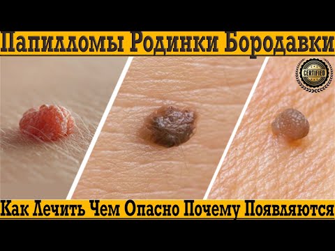 Папилломы, родинки и бородавки! Чем они опасны, почему появляются и как лечить?!