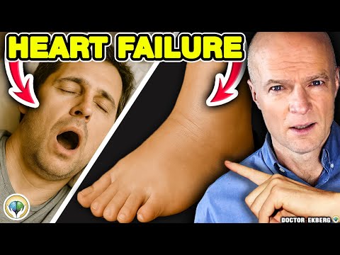 10 Early Signs Of Heart Failure (You Ignore) 10 Early Signs Of Heart Failure (You Ignore)