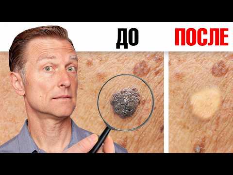Как избавиться от папиллом и бородавок за ОДНУ ночь?👀 Как избавиться от папиллом и бородавок за ОДНУ ночь?👀