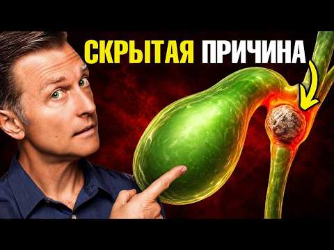 Настоящая причина камней в желчном пузыре: мифы и правда🙌