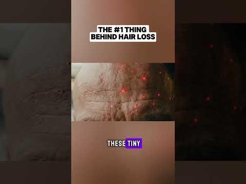 The #1 Cause of Hair Loss (& How to Fix It)