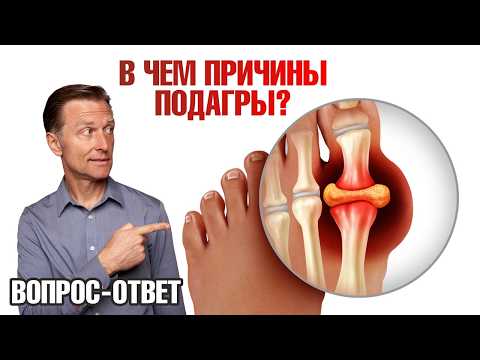 Приступы подагры. Альтернативный взгляд на причины подагры🧐
